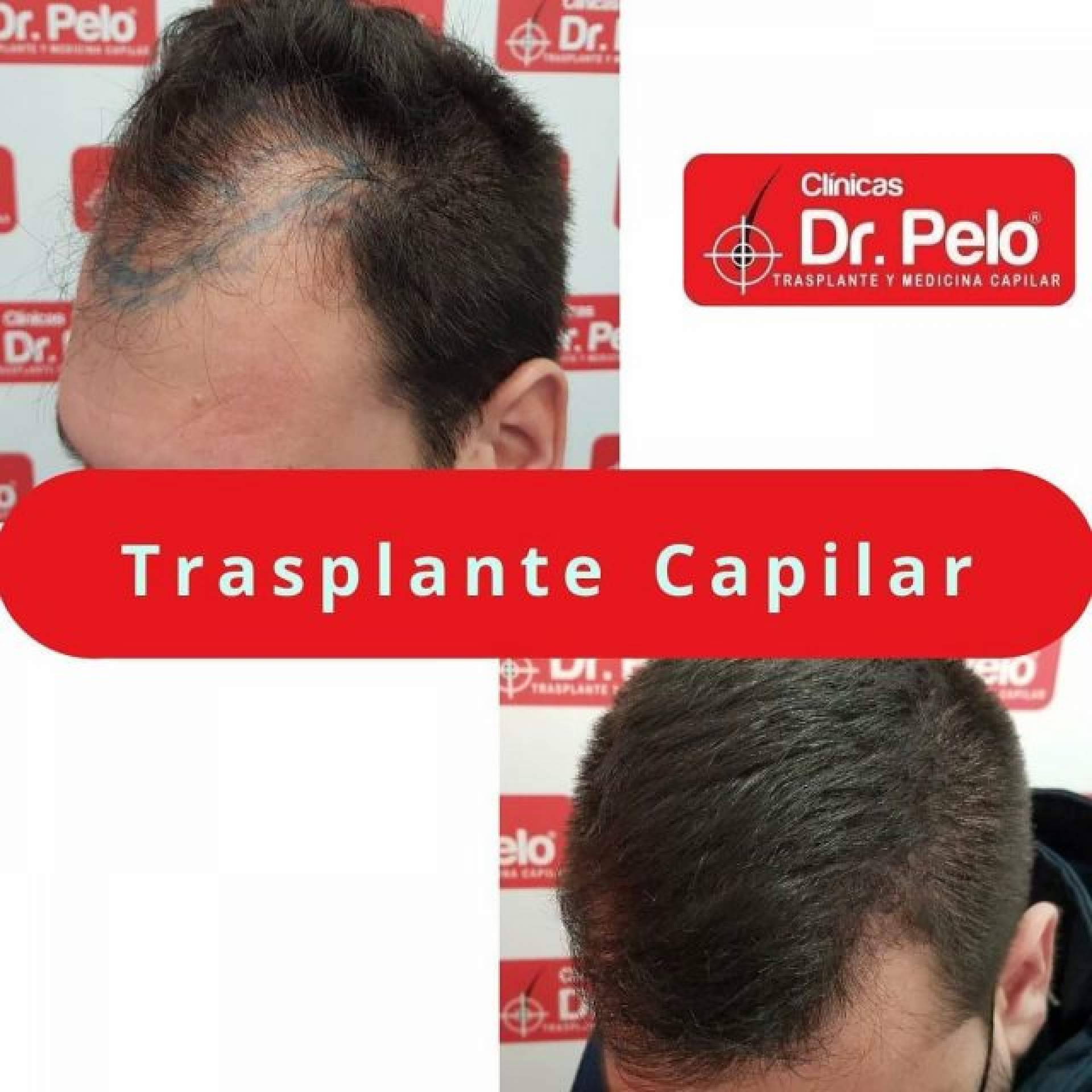 ¿Cómo frenar las entradas en el pelo gracias a las Clínicas Dr. Pelo? La importancia del trasplante capilar cuando se pierde cabello