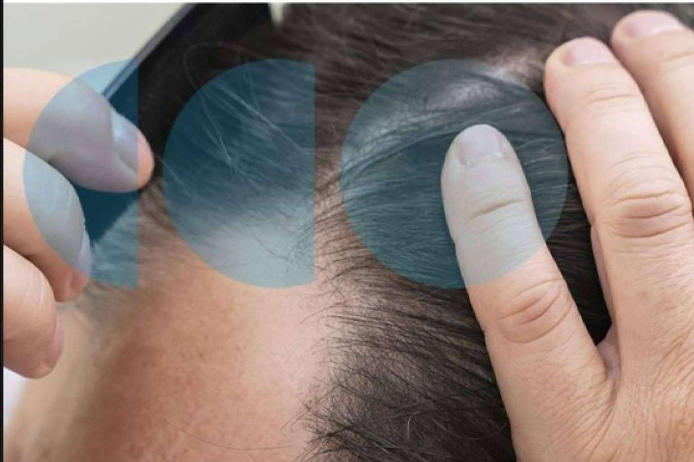 La caída de cabello estacional viene más fuerte este año